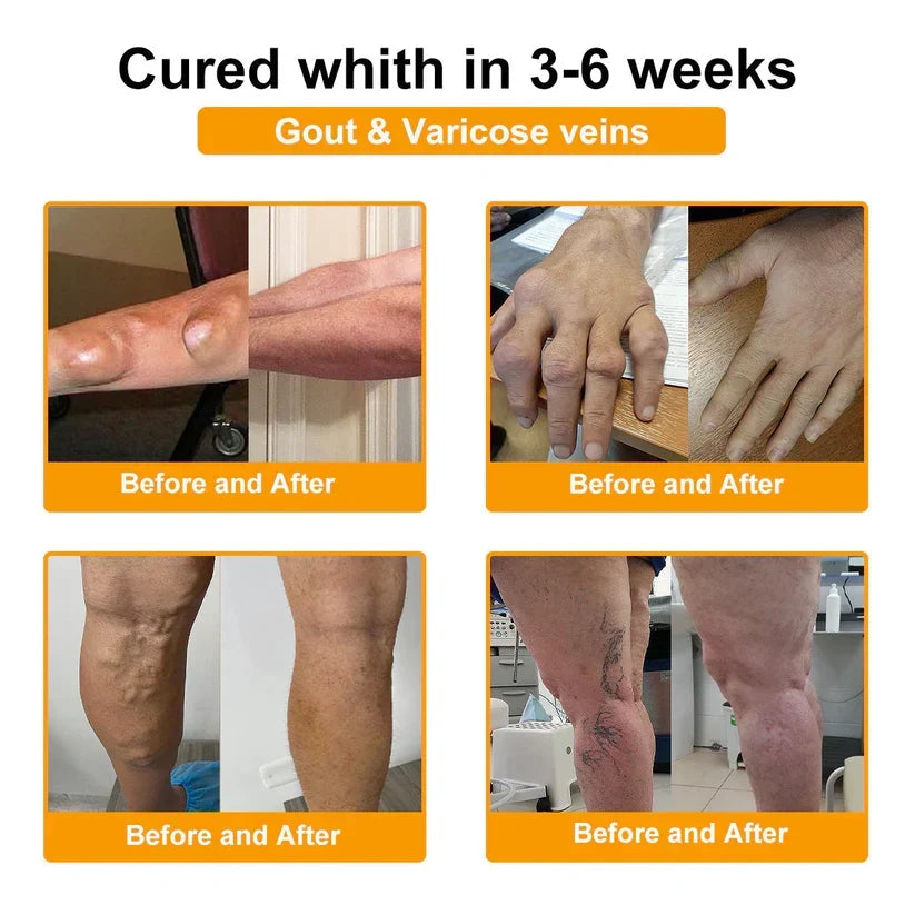 🎁👨‍⚕️Official Shop:Rolimey® Bee Venom Pain Relief Bone Healing Cream 👨‍⚕️(Reduction of joint swelling, pain, stiffness, redness, heat, muscle soreness and joint fatigue)