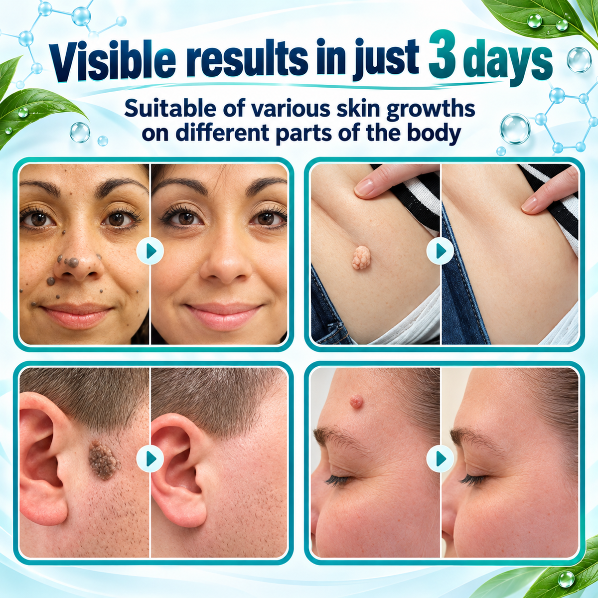 🎁👨‍⚕️GFOUK® 2026 Newly Upgraded 2-in-1 Microneedle Hydrocolloid Patches🍀  | Removes Raised Moles, Acne, Flat Warts, and Skin Tags | Improves Wrinkles, Scars, and Blemishes | Invisible Acne Patches for Face & Body
