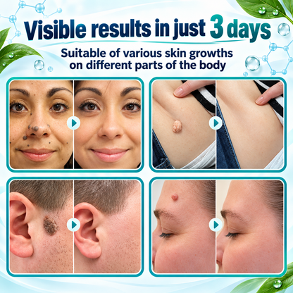 🎁👨‍⚕️GFOUK® 2026 Newly Upgraded 2-in-1 Microneedle Hydrocolloid Patches🍀  | Removes Raised Moles, Acne, Flat Warts, and Skin Tags | Improves Wrinkles, Scars, and Blemishes | Invisible Acne Patches for Face & Body