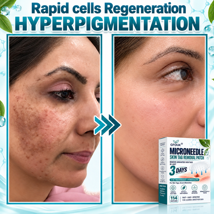 🎁👨‍⚕️GFOUK® 2026 Newly Upgraded 2-in-1 Microneedle Hydrocolloid Patches🍀  | Removes Raised Moles, Acne, Flat Warts, and Skin Tags | Improves Wrinkles, Scars, and Blemishes | Invisible Acne Patches for Face & Body
