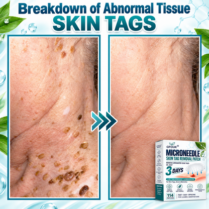 🎁👨‍⚕️GFOUK® 2026 Newly Upgraded 2-in-1 Microneedle Hydrocolloid Patches🍀  | Removes Raised Moles, Acne, Flat Warts, and Skin Tags | Improves Wrinkles, Scars, and Blemishes | Invisible Acne Patches for Face & Body