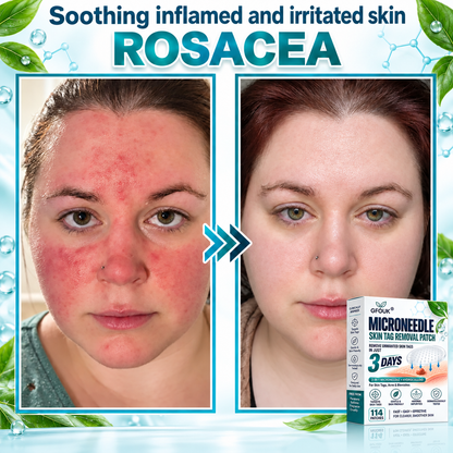 🎁👨‍⚕️GFOUK® 2026 Newly Upgraded 2-in-1 Microneedle Hydrocolloid Patches🍀  | Removes Raised Moles, Acne, Flat Warts, and Skin Tags | Improves Wrinkles, Scars, and Blemishes | Invisible Acne Patches for Face & Body