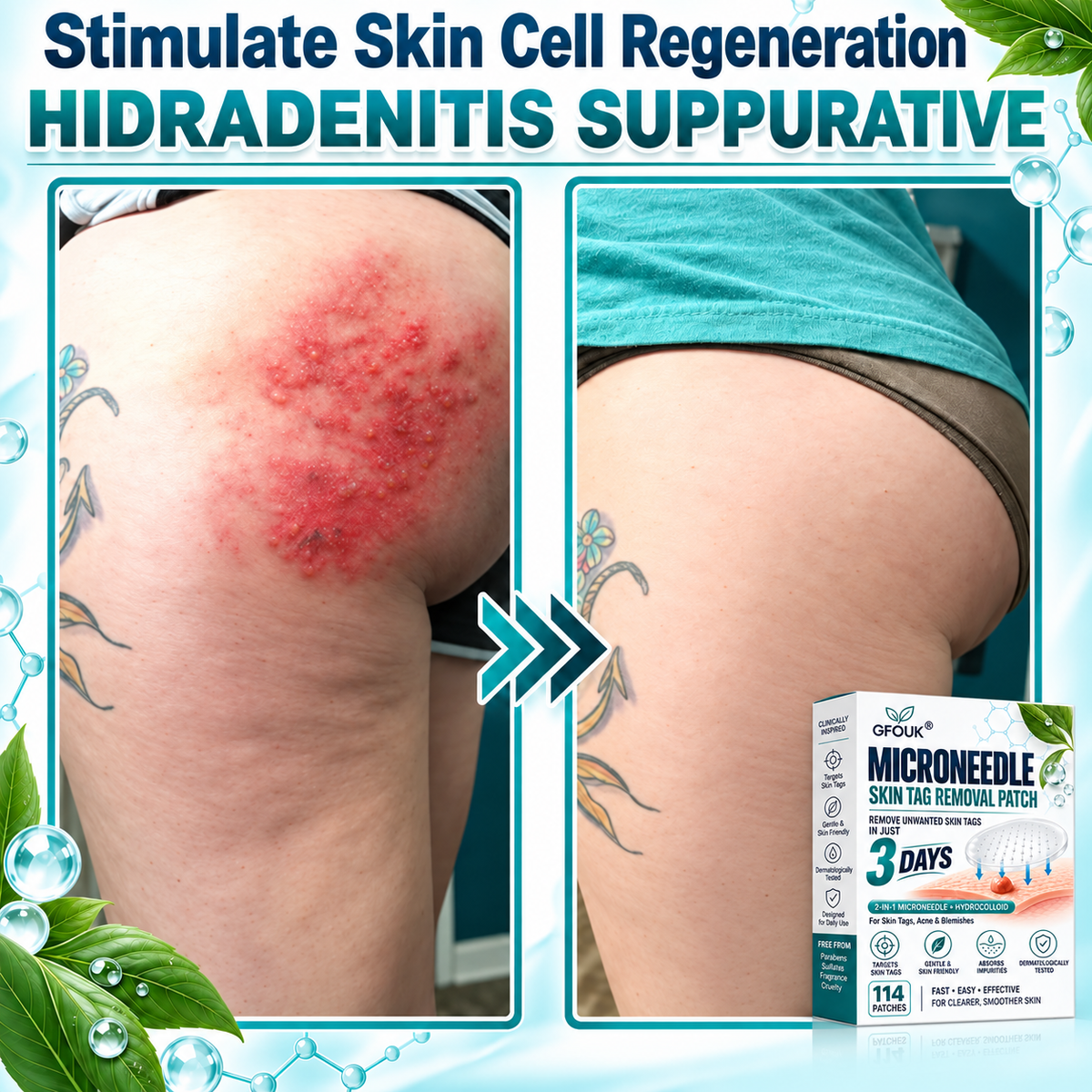 🎁👨‍⚕️GFOUK® 2026 Newly Upgraded 2-in-1 Microneedle Hydrocolloid Patches🍀  | Removes Raised Moles, Acne, Flat Warts, and Skin Tags | Improves Wrinkles, Scars, and Blemishes | Invisible Acne Patches for Face & Body