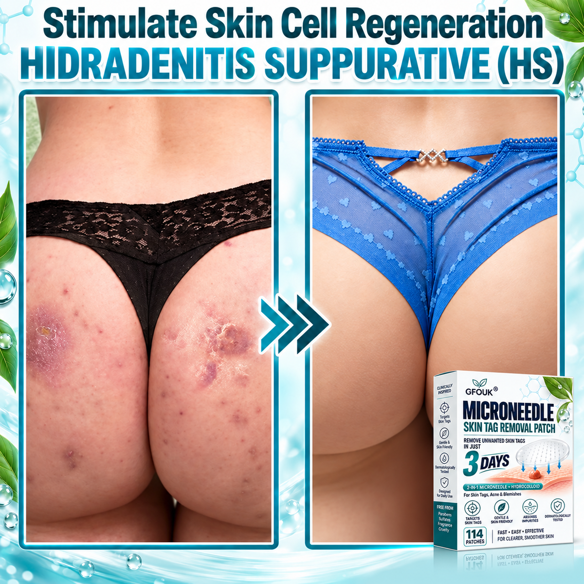 🎁👨‍⚕️GFOUK® 2026 Newly Upgraded 2-in-1 Microneedle Hydrocolloid Patches🍀  | Removes Raised Moles, Acne, Flat Warts, and Skin Tags | Improves Wrinkles, Scars, and Blemishes | Invisible Acne Patches for Face & Body