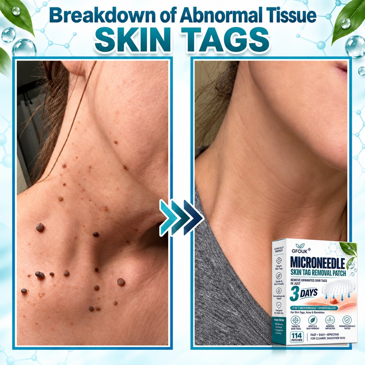 🎁👨‍⚕️GFOUK® 2026 Newly Upgraded 2-in-1 Microneedle Hydrocolloid Patches🍀  | Removes Raised Moles, Acne, Flat Warts, and Skin Tags | Improves Wrinkles, Scars, and Blemishes | Invisible Acne Patches for Face & Body
