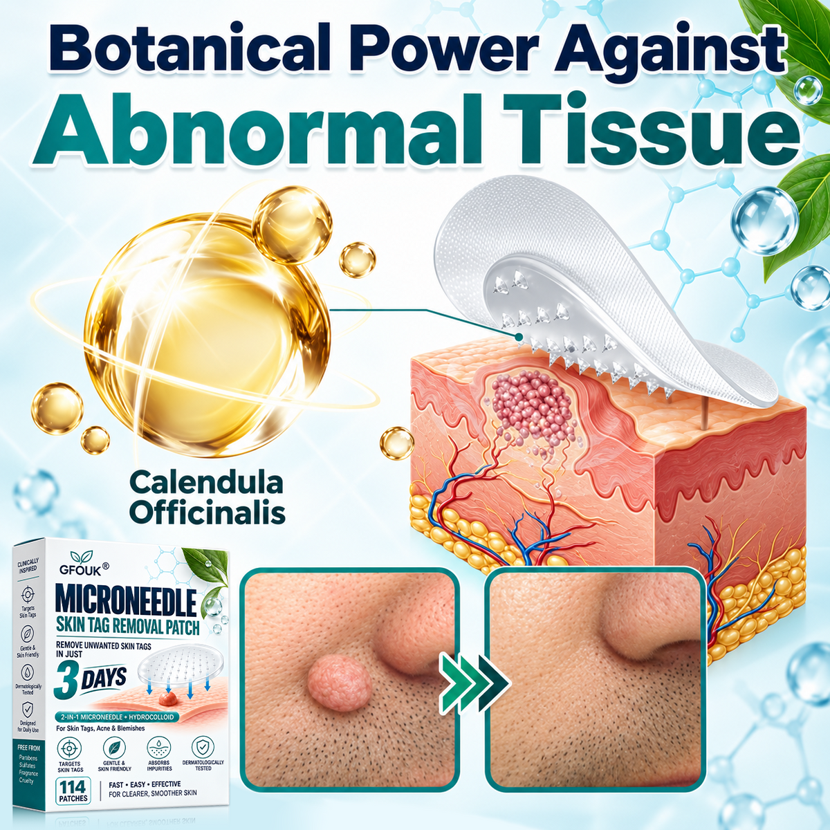 🎁👨‍⚕️GFOUK® 2026 Newly Upgraded 2-in-1 Microneedle Hydrocolloid Patches🍀  | Removes Raised Moles, Acne, Flat Warts, and Skin Tags | Improves Wrinkles, Scars, and Blemishes | Invisible Acne Patches for Face & Body