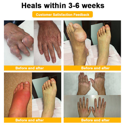 🎁👨‍⚕️Official Shop:Rolimey® Bee Venom Pain Relief Bone Healing Cream 👨‍⚕️(Reduction of joint swelling, pain, stiffness, redness, heat, muscle soreness and joint fatigue)