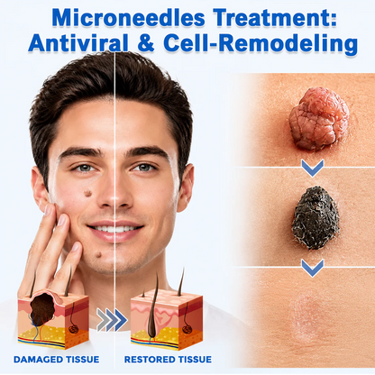 GFOUK® 2-in-1 Microneedle & Hydrocolloid Patch🍀 | Removes raised moles, acne, flat warts, and skin tags | Invisible patches for face and body