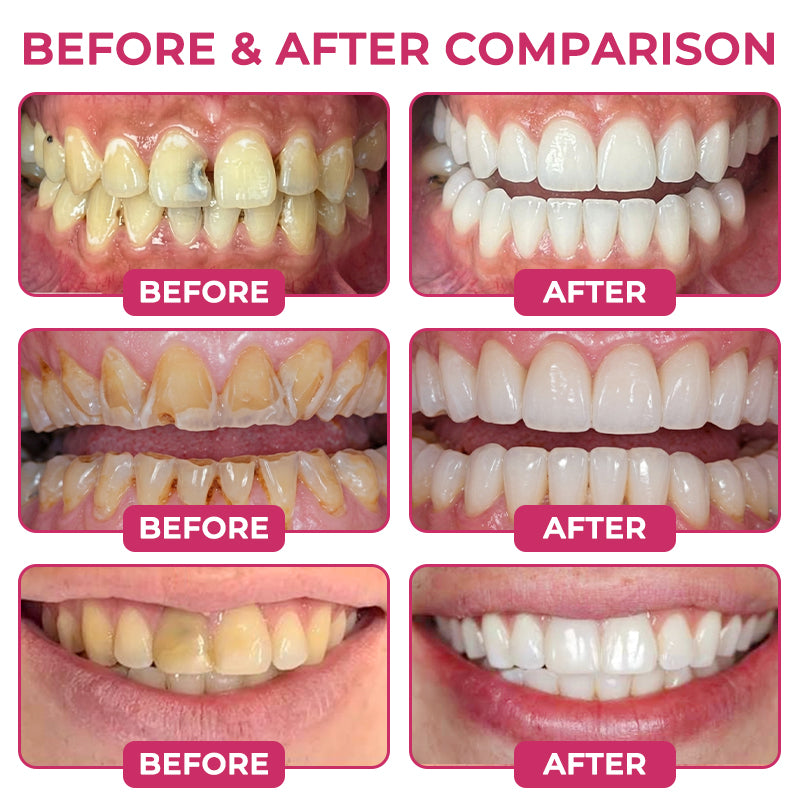 🇺🇸👩‍⚕️🦷😊Rolimey® DenPerm Cavity-Repair Natural Enamel Filling Gel