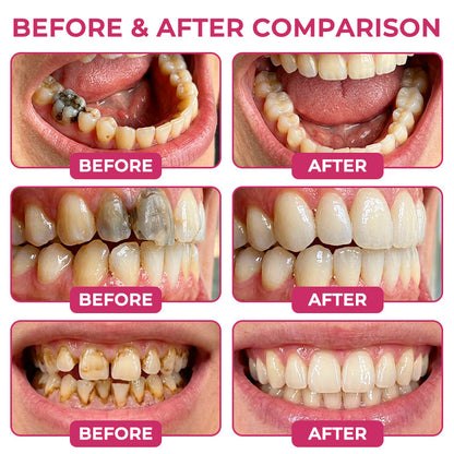 🇺🇸👩‍⚕️🦷😊Rolimey® DenPerm Cavity-Repair Natural Enamel Filling Gel