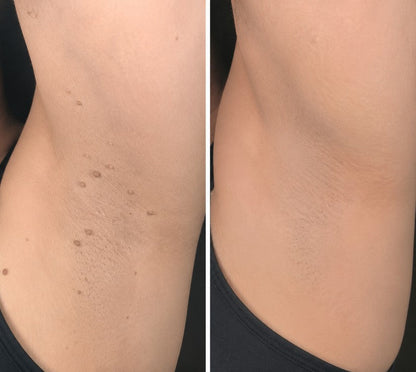 GFOUK® 2-in-1 Microneedle & Hydrocolloid Patch🍀 | Removes raised moles, acne, flat warts, and skin tags | Invisible patches for face and body